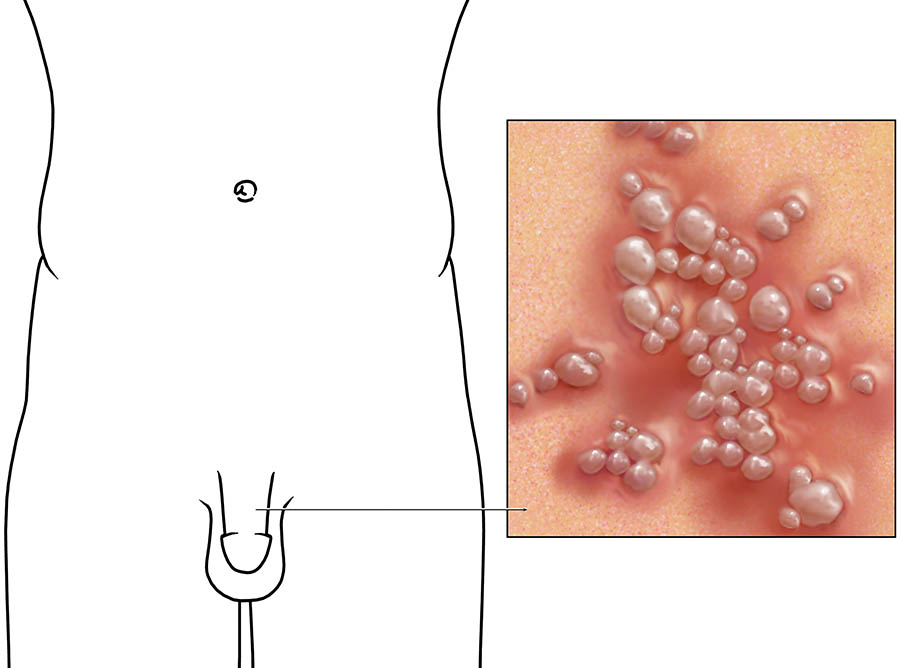 genital-herpes-1.jpg